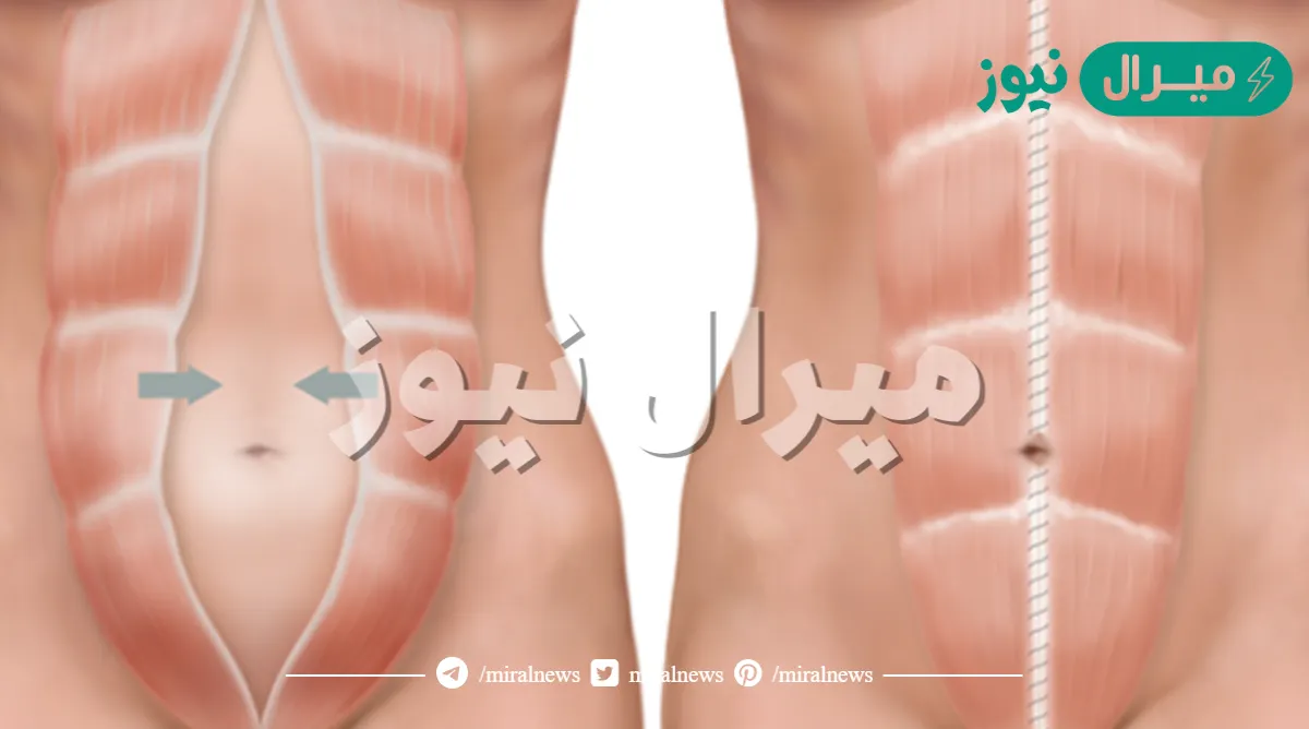 ما هو الانفصال العضلي
