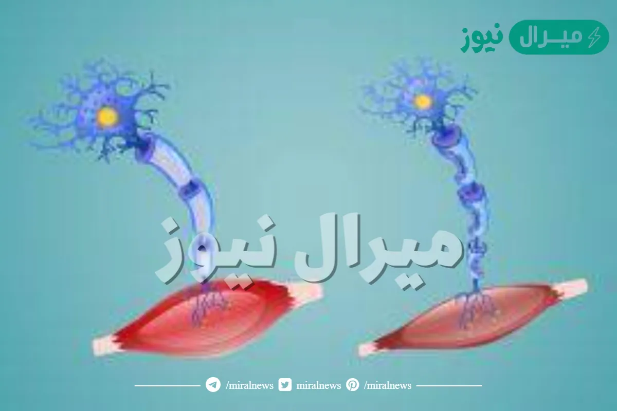 ما هو مرض التصلب الجانبي الضموري