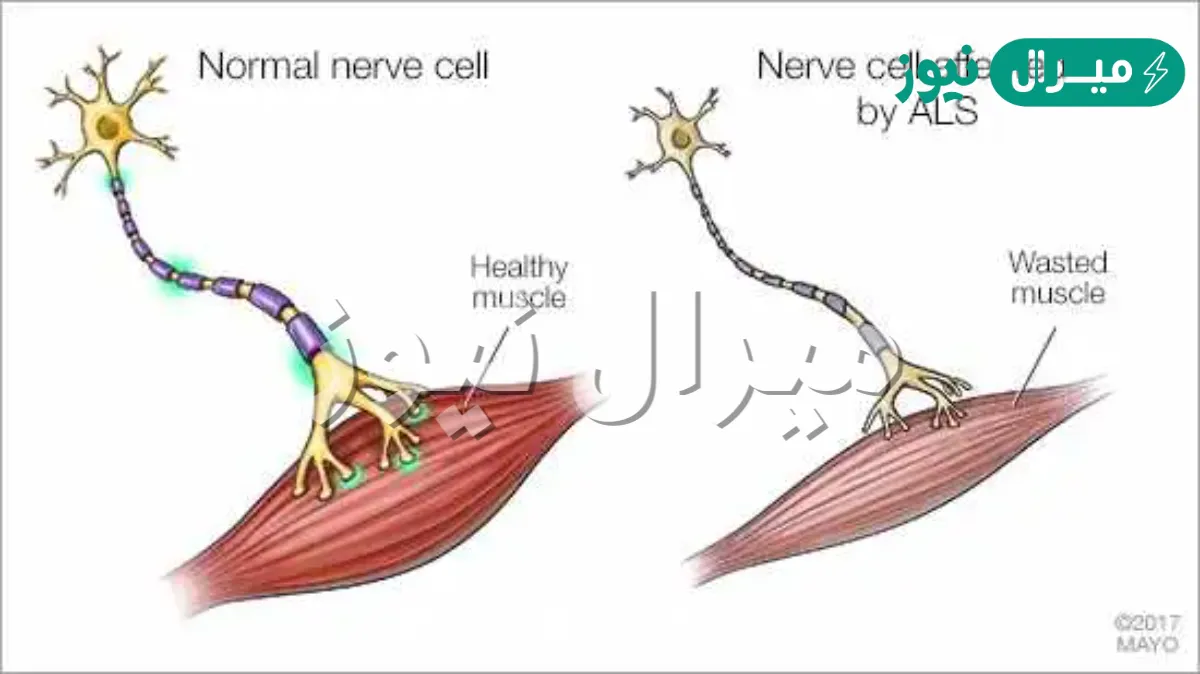 ما هو مرض التصلب الجانبي