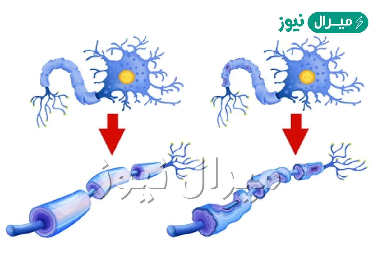 ما هي متلازمة غيلان باريه وأسبابها وطرق علاجها