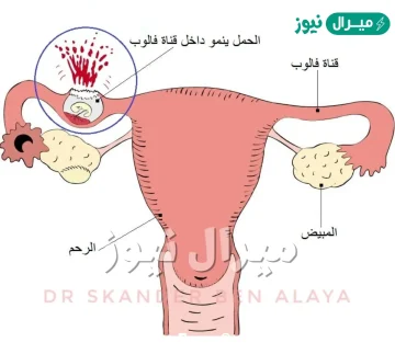 متى تبدا اعراض الحمل خارج الرحم بالظهور