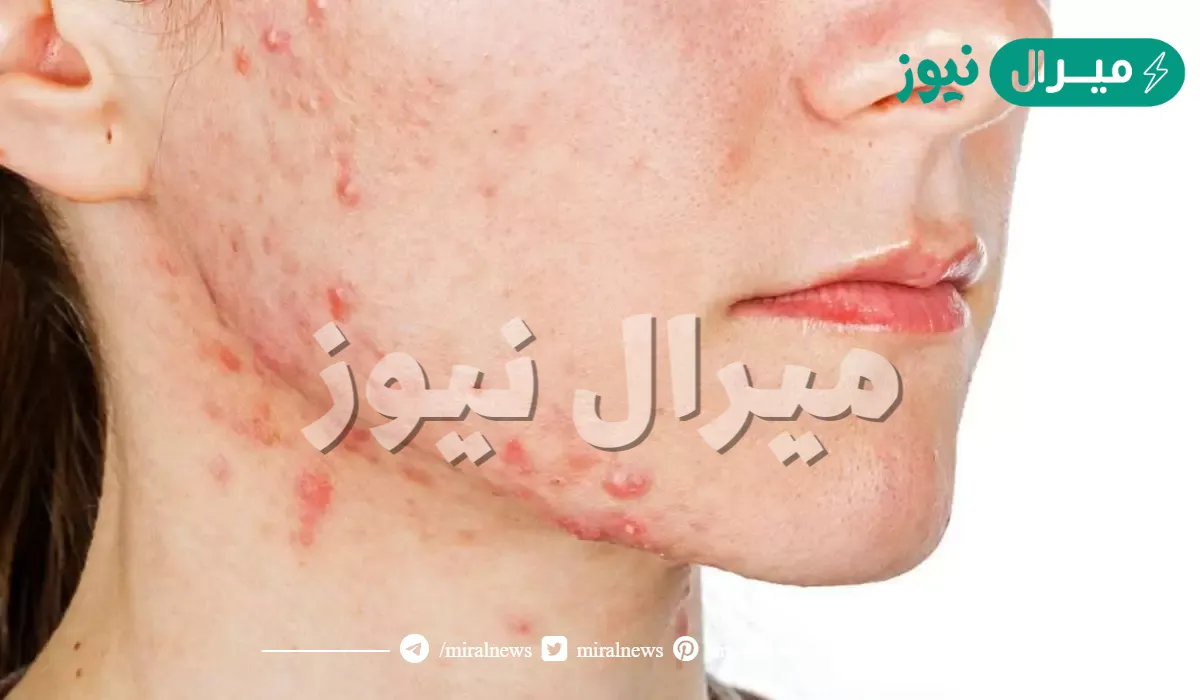 مين طلع لها حبوب في الوجه وطلعت حامل| متى تظهر حبوب الحمل