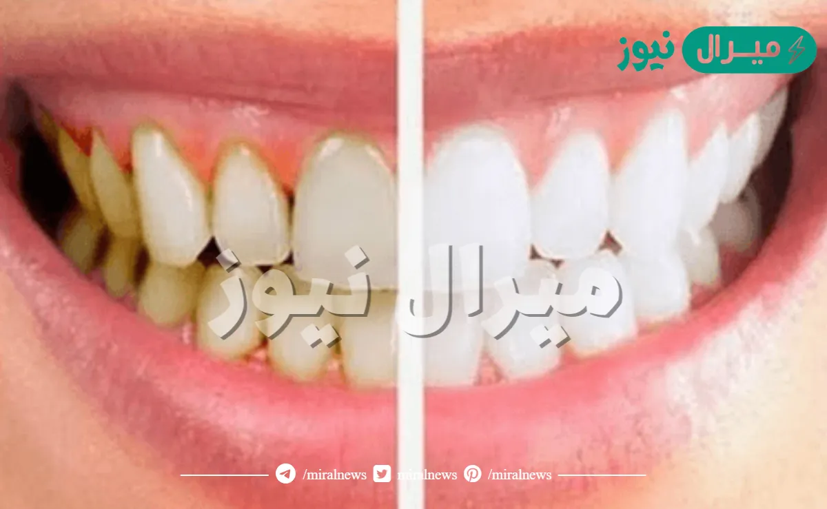 طريقة تنظيف الأسنان من الاصفرار والجير بمكونات طبيعية من المنزل لاستعادة الابتسامه الجميلة البيضاء