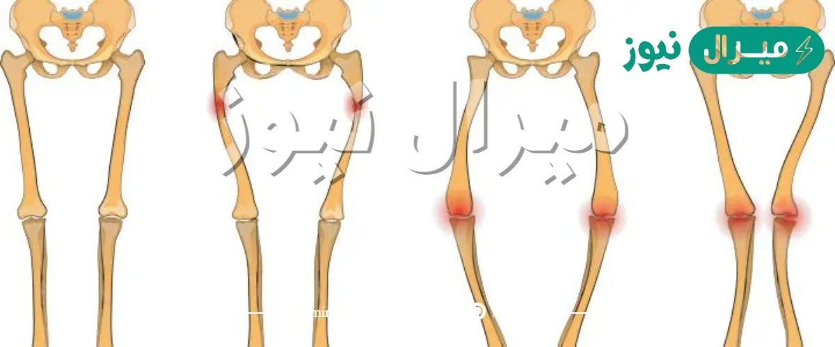 ما هي العظام التي يولد الأطفال بدونها؟