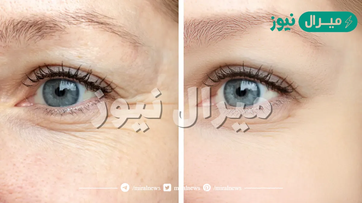 هتكوني زي الأميرات… اقوي وارخص بوتكس لشد البشرة وتفتيحها والتخلص من تجاعيد الوجه تمتعى ببشرة كالأطفال