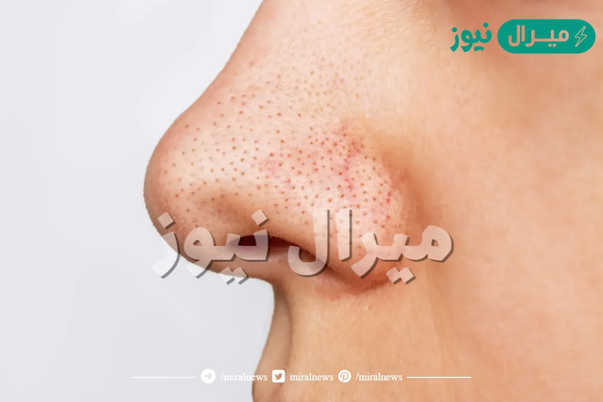 لبشرة خالية من العيوب.. تخلصي من الرؤوس السوداء بمكونات طبيعية فعالة