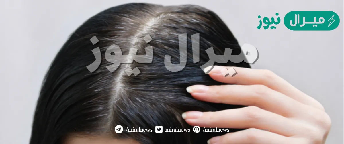 بمكون واحد… طريقة التخلص من الشعر الأبيض بوصفة غير مكلفة وفعالة من أول استخدام