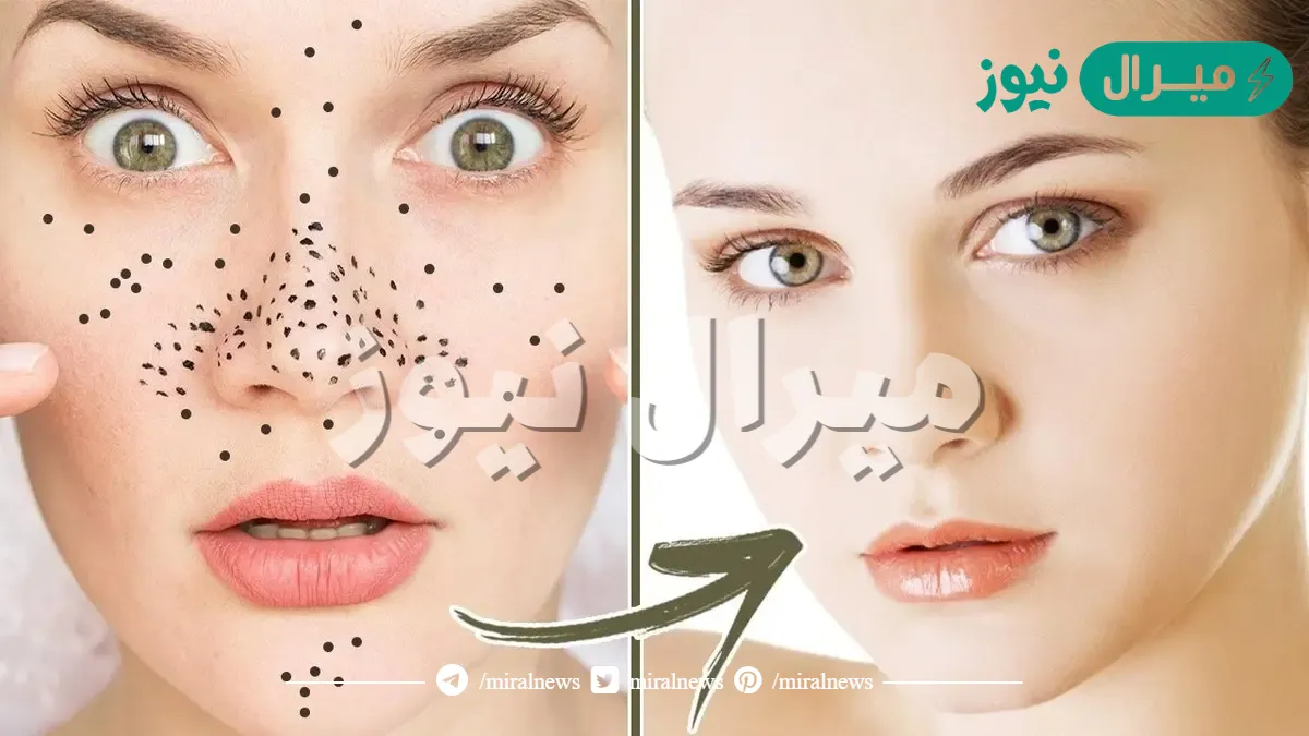 ماسكات رائعة.. وداعا للرؤوس السوداء تمتعي ببشرة صافية بسهولة وتبيض فوري للوجه من اول استعمال