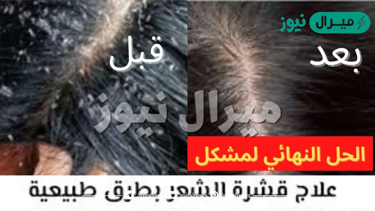 وصفة لازالة القشرة من الشعر