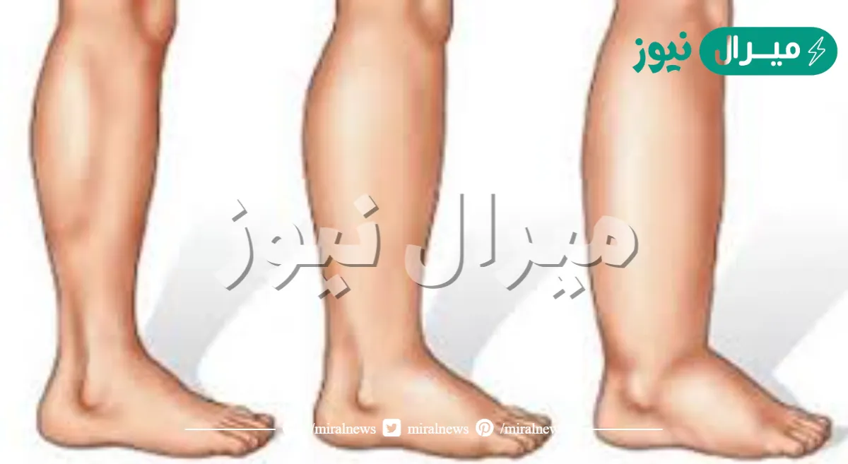 اسباب احتباس الماء في الجسم