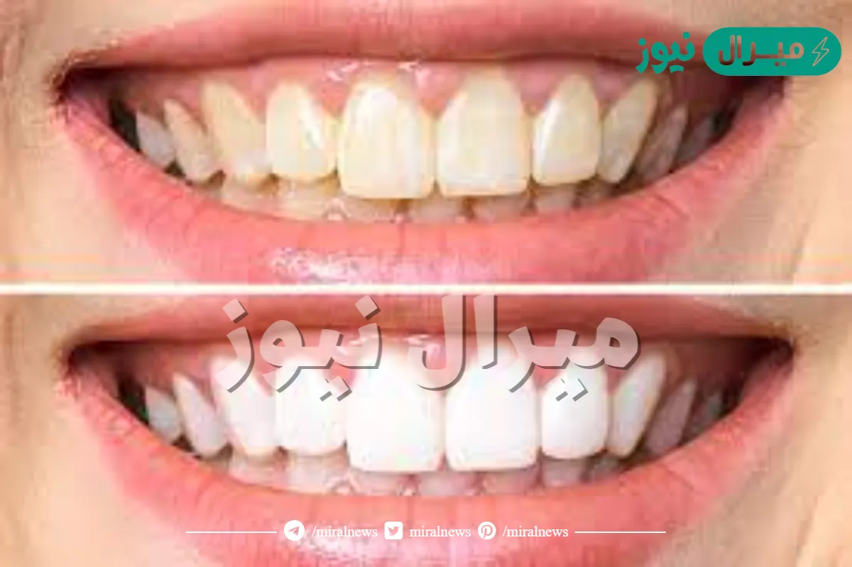 ابتسامة هوليود قبل وبعد
