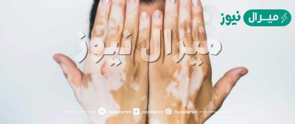 الفرق بين البهاق والبرص