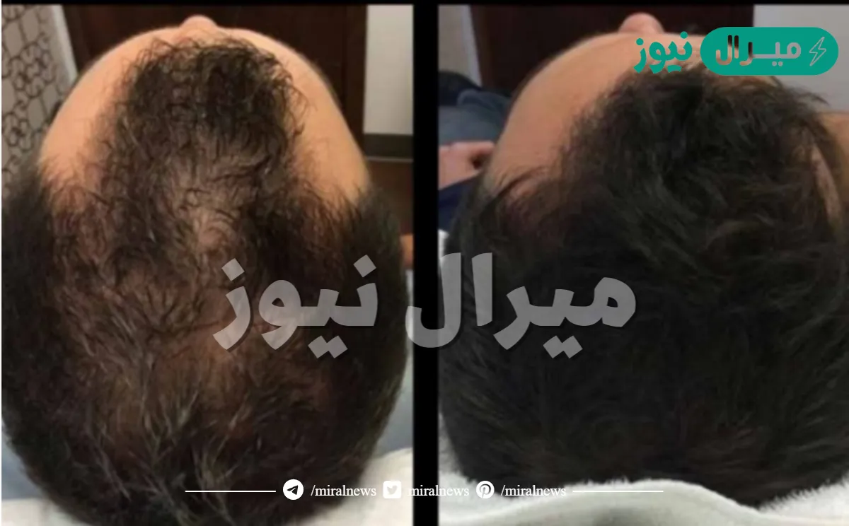 الفرق بين الخلايا الجذعية والبلازما للشعر