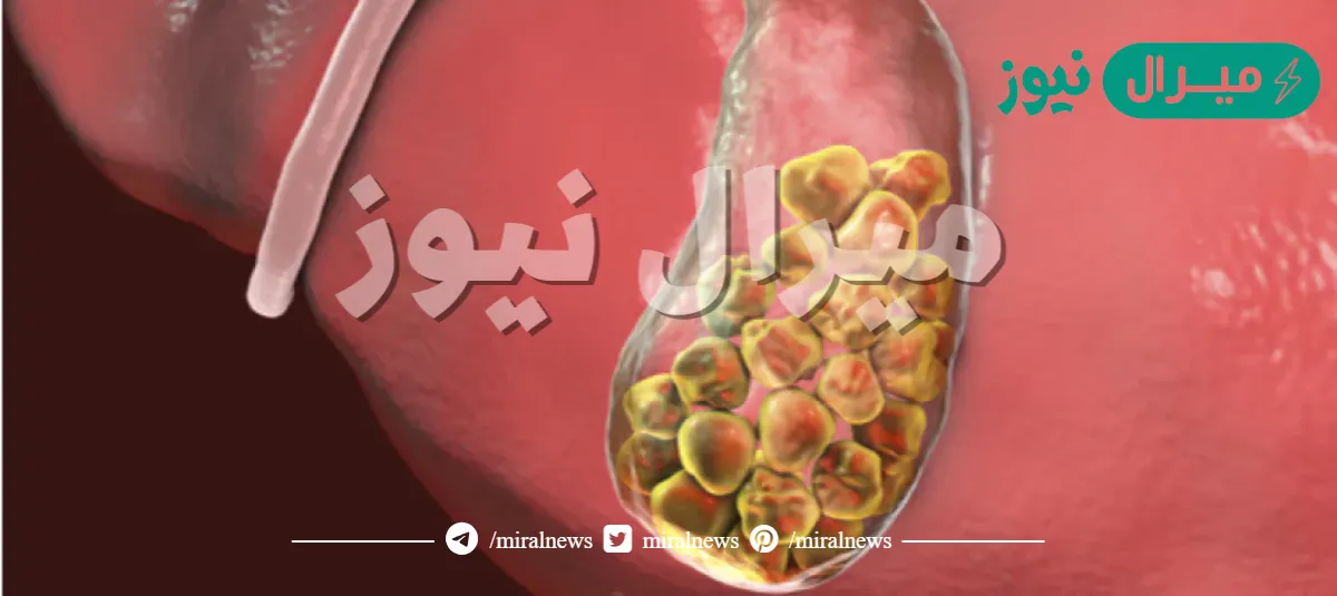 تجربتي في تفتيت حصوة المرارة