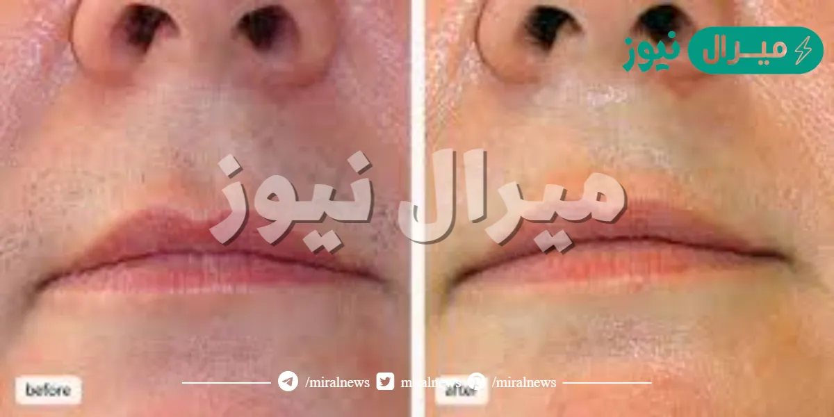 تجربتي مع الليزر للوجه