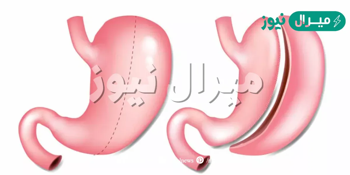 تجربتي مع عملية تكميم المعدة