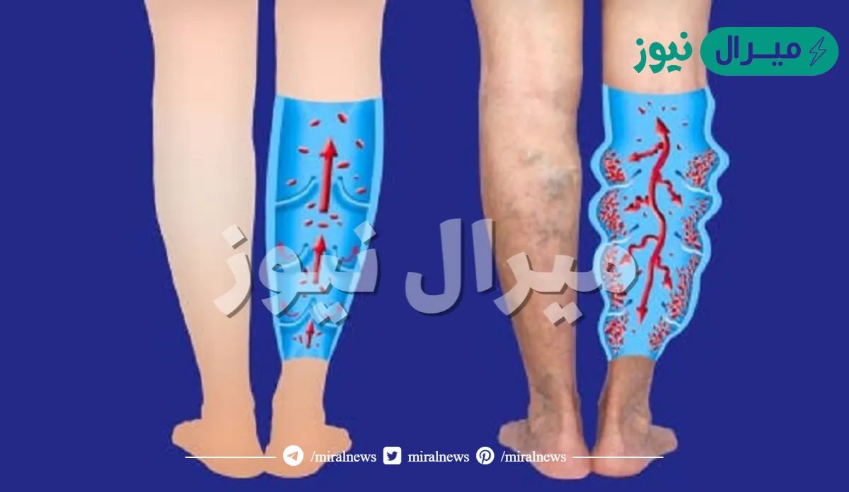 تجربتي مع جلطة الساق وأعراضها وكيفية علاجها – طريقة تشخيص الجلطة في القدم