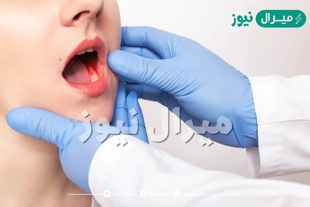 تجربتي مع سرطان الفم وأعراضه وكيفية علاجه