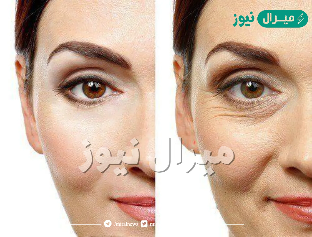 تجربتي مع شد الوجه بالخيوط الذهبيه بعد 30 يوم | مميزات خيوط شد الوجه