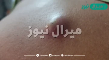 كيف اعرف الكيس الدهني من الورم