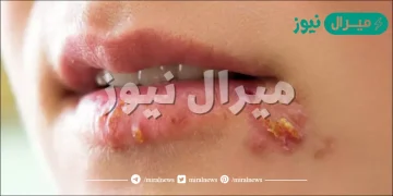ما هو فيروس الهربس وأهم أعراضه