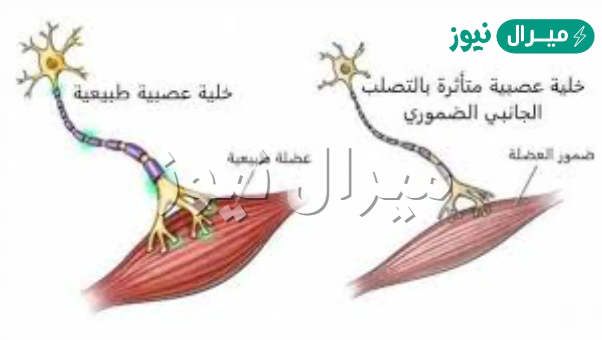 اسباب مرض التصلب الجانبي الضموري