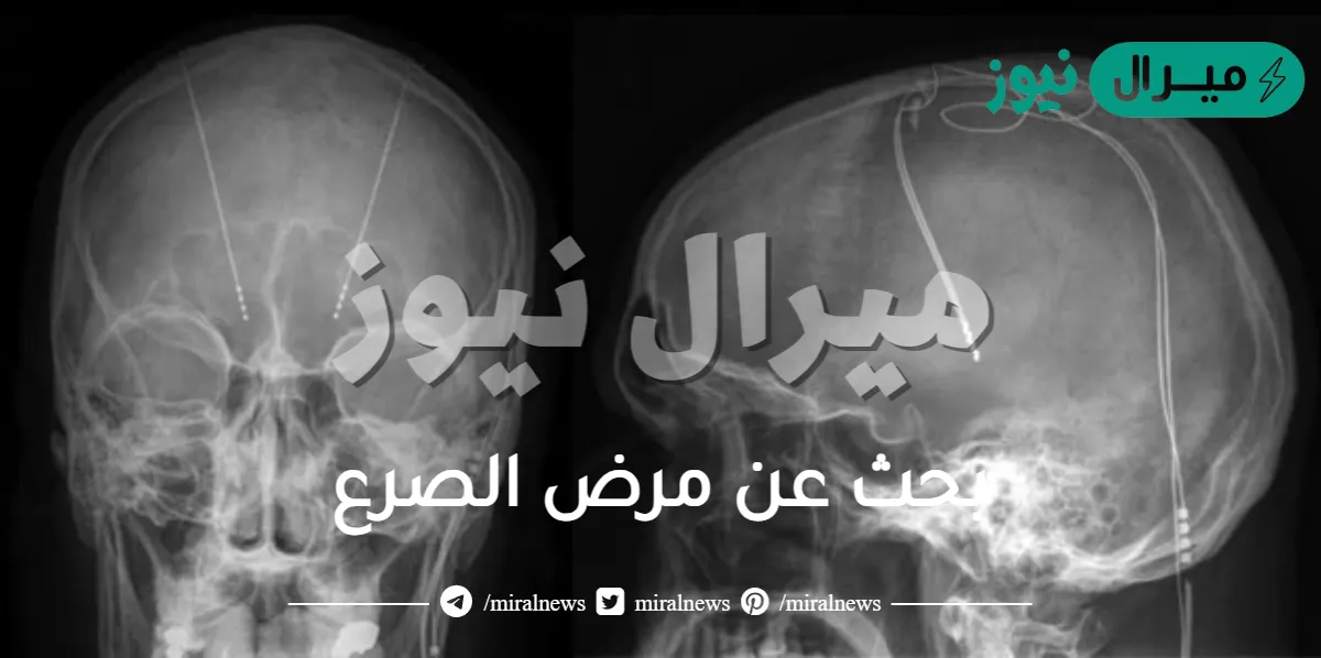 بحث عن مرض الصرع