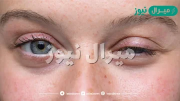 ما هو الوهن العضلي