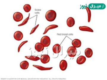 ما هو فقر الدم المنجلي