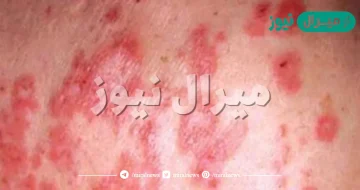 ما هو مرض الذئبة الحمراء ؟