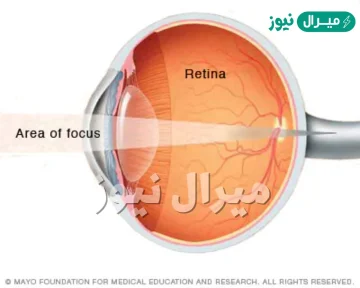 عيب في الرؤية حيث يستطيع الشخص المصاب به رؤية الجسم البعيد بوضوح ولا يرى القريب