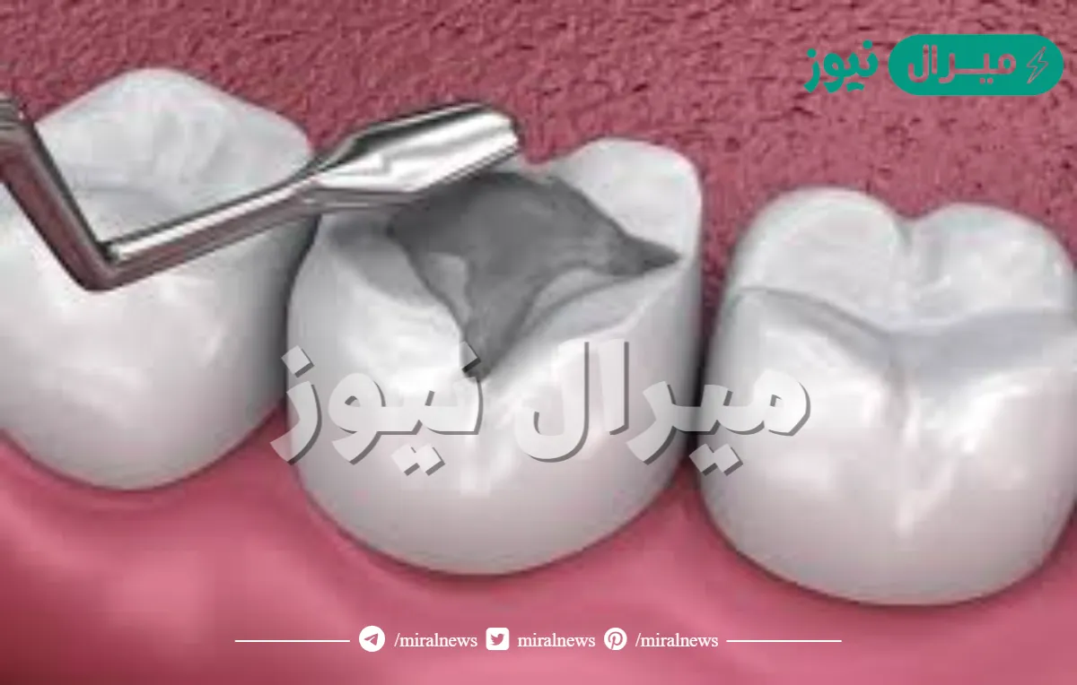 يستخدم طبيب الأسنان في الحشوات مواد لها معامل تمدد أكبر من مينا الأسنان
