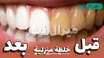 اسنانك لؤلؤ في دقيقتين .. خلطة طبيعية لتنظيف وتبييض الاسنان في دقائق بدون مواد ضارة