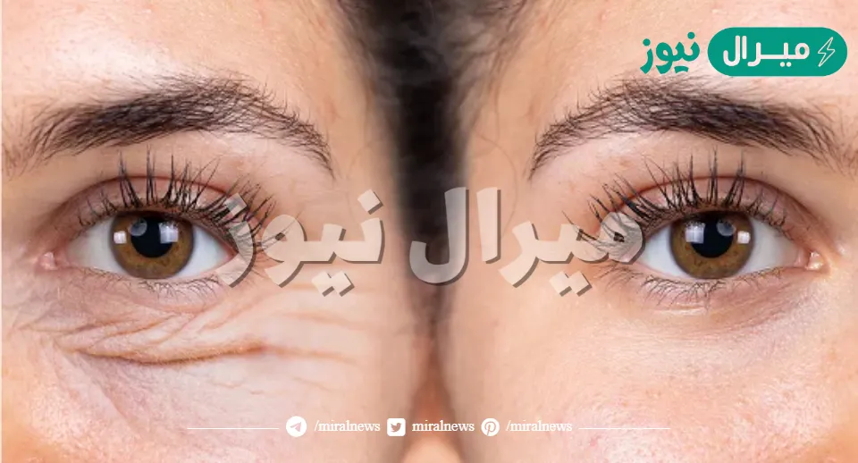 أقوي الخلطات الطبيعية لإزالة التجاعيد تحت العين وتخفيف الانتفاخات