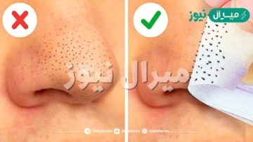 إزالة الرؤوس السوداء بطريقة مضمونة ومكونات طبيعية في المنزل