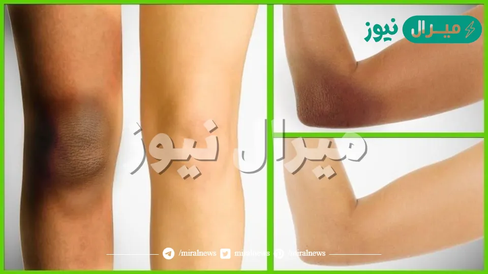 تحدي التقشير والتفتيح للركب والأكواع بوصفة منزلية سريعة المفعول لن تصدقي النتيجة