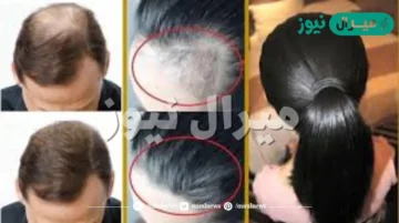 وصفة صاروخية لملئ وإنبات فراغات الشعر وعلاج الصلع نهائياً شعرك هينمو بدون توقف