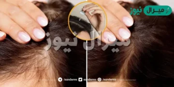 أفضل وأسرع الطرق لعلاج تساقط الشعر وانبات فراغات فروة الرأس