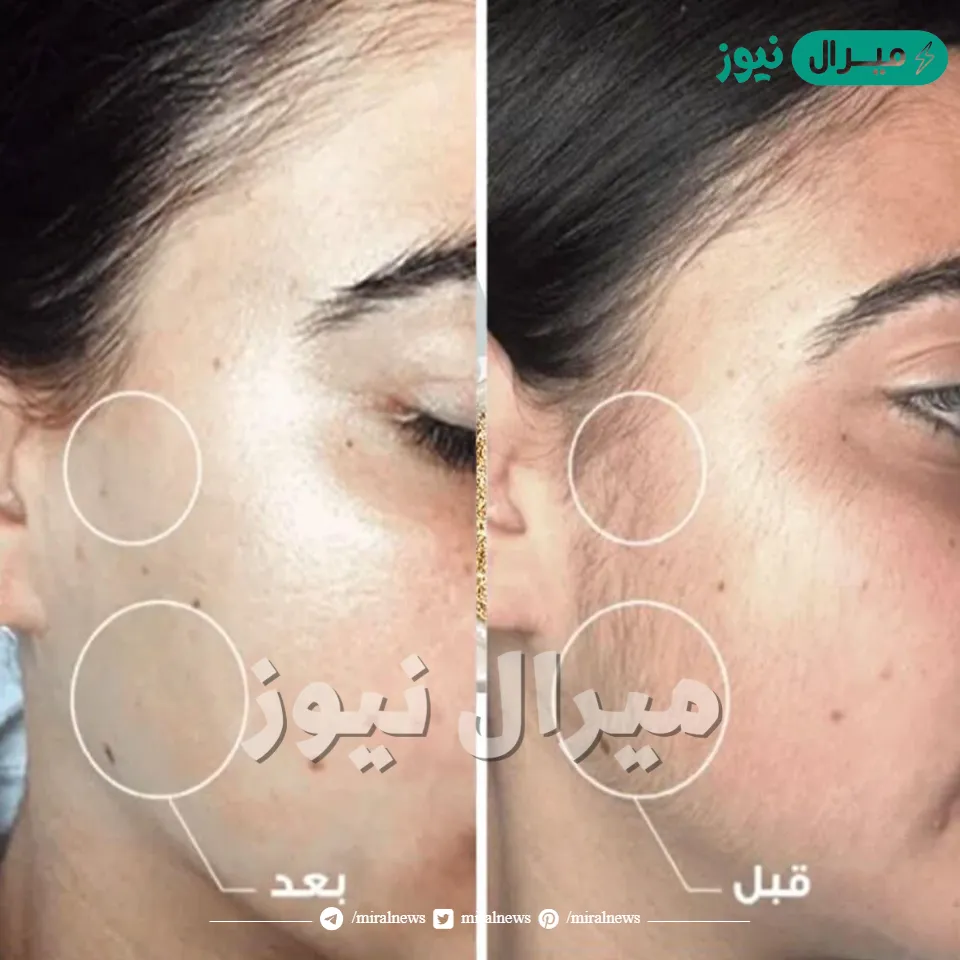 اقوى كريم مبهر لإزالة شعر الوجة والجسم بالكامل والاماكن الحساسة بدون الم نهائيا فى 3 ثوانى